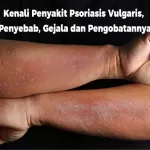 Kenali Apa Itu Penyakit Psoriasis Vulgaris, Penyebab, Gejala dan Pengobatannya
