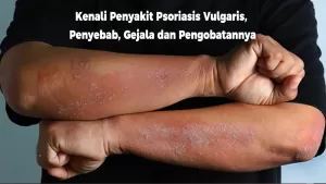 Kenali Apa Itu Penyakit Psoriasis Vulgaris, Penyebab, Gejala dan Pengobatannya