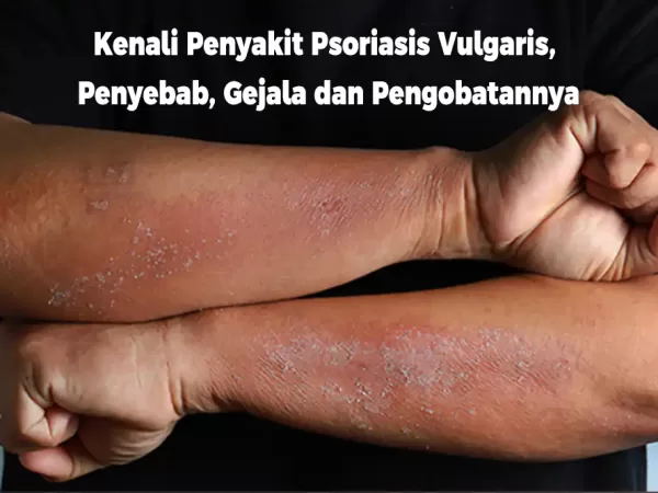 Kenali Apa Itu Penyakit Psoriasis Vulgaris, Penyebab, Gejala dan Pengobatannya